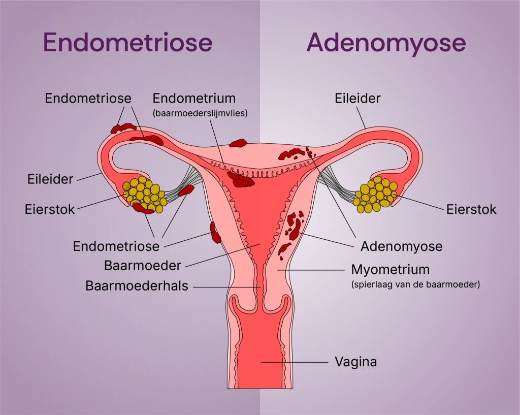 De afbeelding laat zien wat het verschil tussen endometriose en adenomyose is.